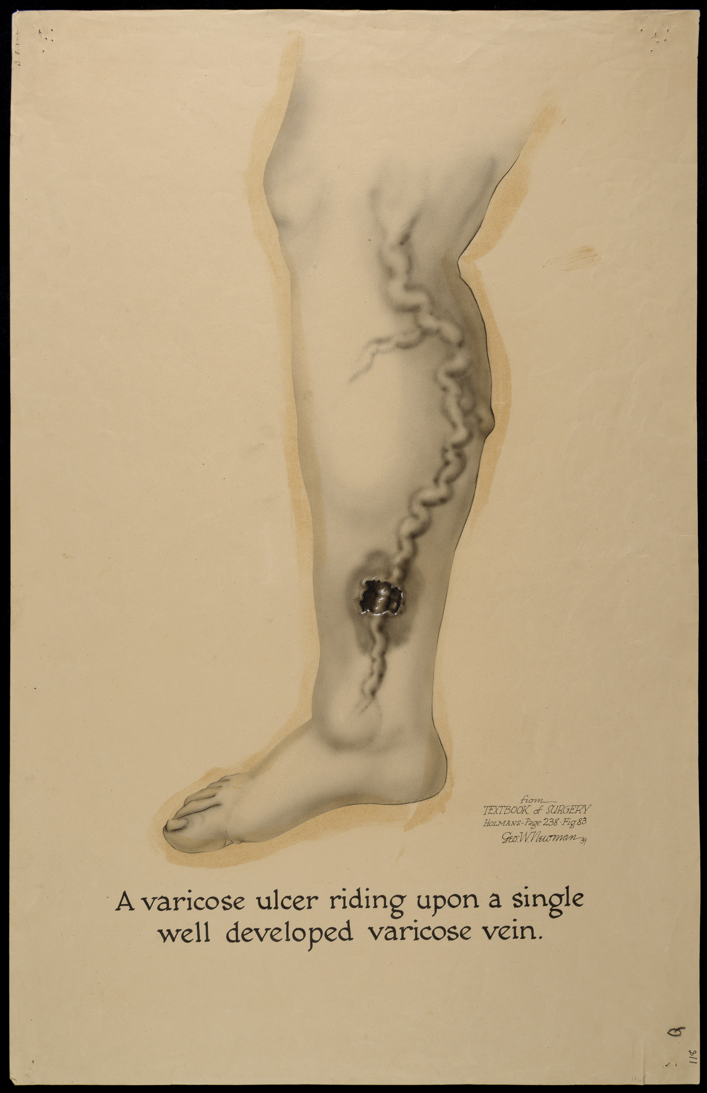 tratamente folclorice pentru stadiul iniial al varicozei cum la anesthety varicoza pe picioare